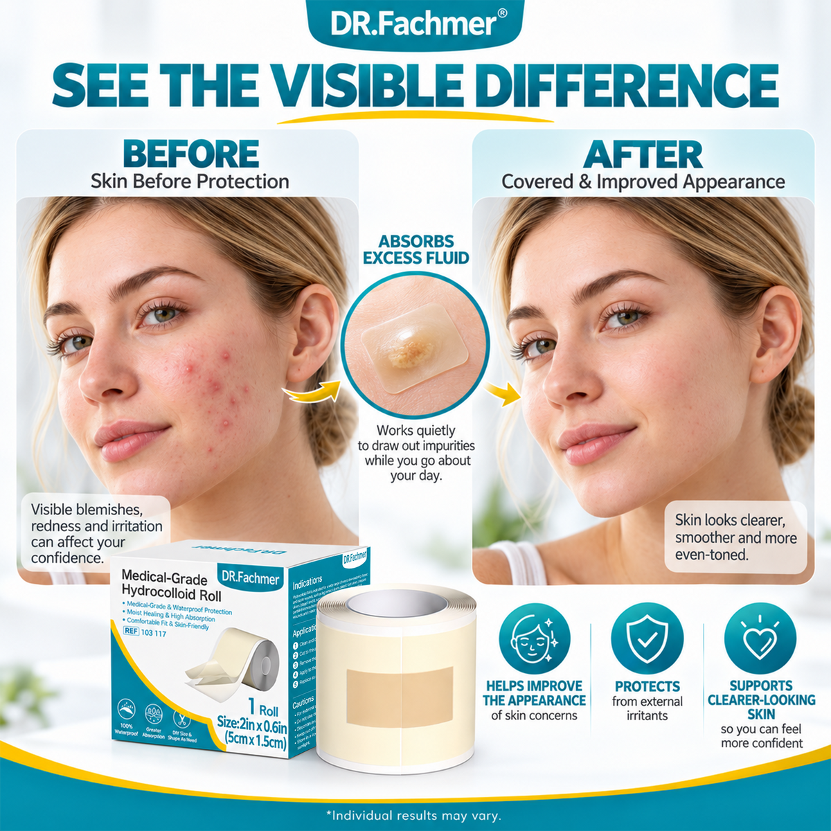 ⭐ DR.Fachmer® Hydrocolloid Acne Patch Roll – Custom-Cut Overnight Pimple Care